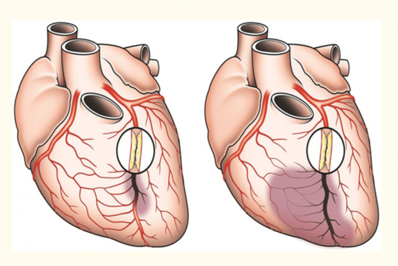Что такое шунтирование сердца и сосудов. Коронарное шунтирование сосудов сердца. Шунтирование артерий сердца. Коронарные сосуды сердца. Сердце человека анатомия коронарных артерий.