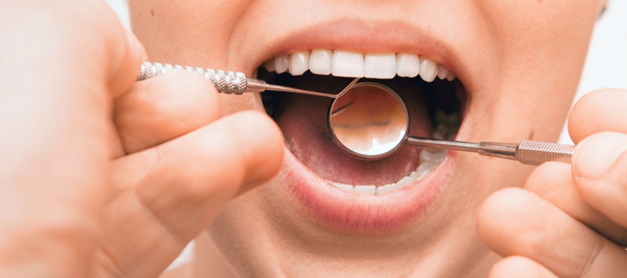 Diş Çürüğü Belirtileri Nelerdir? Diş Çürükleri Nasıl Önlenir?