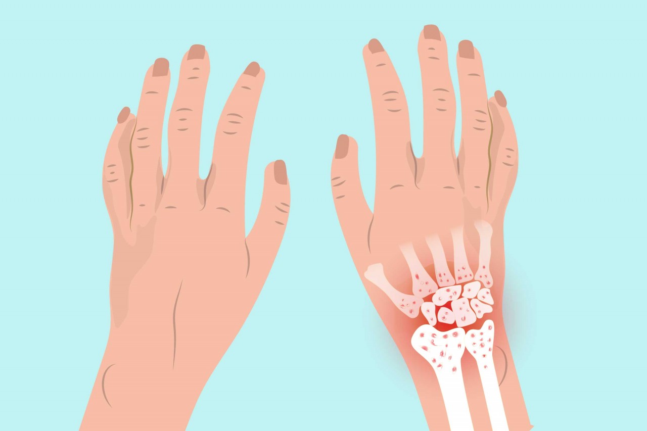 El Artriti: Belirtileri, Tedavisi ve Daha Fazlası