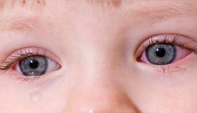 Pembe Göz (Konjonktivit) Tedavisi İçin En İyi Öneriler