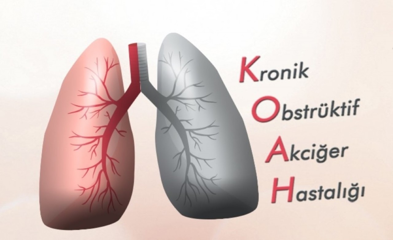 Kronik Obstrüktif Akciğer Hastalığı (KOAH) Hakkında Bilmeniz Gereken Her Şey