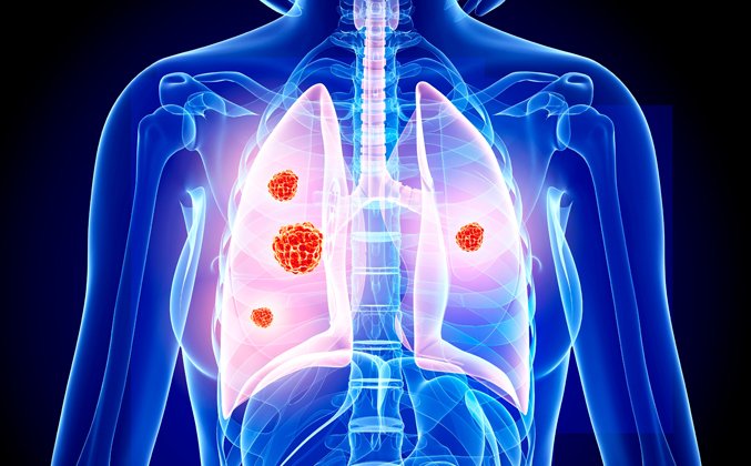 Küçük Hücreli Akciğer Kanseri Nedir? Bilmeniz Gerekenler