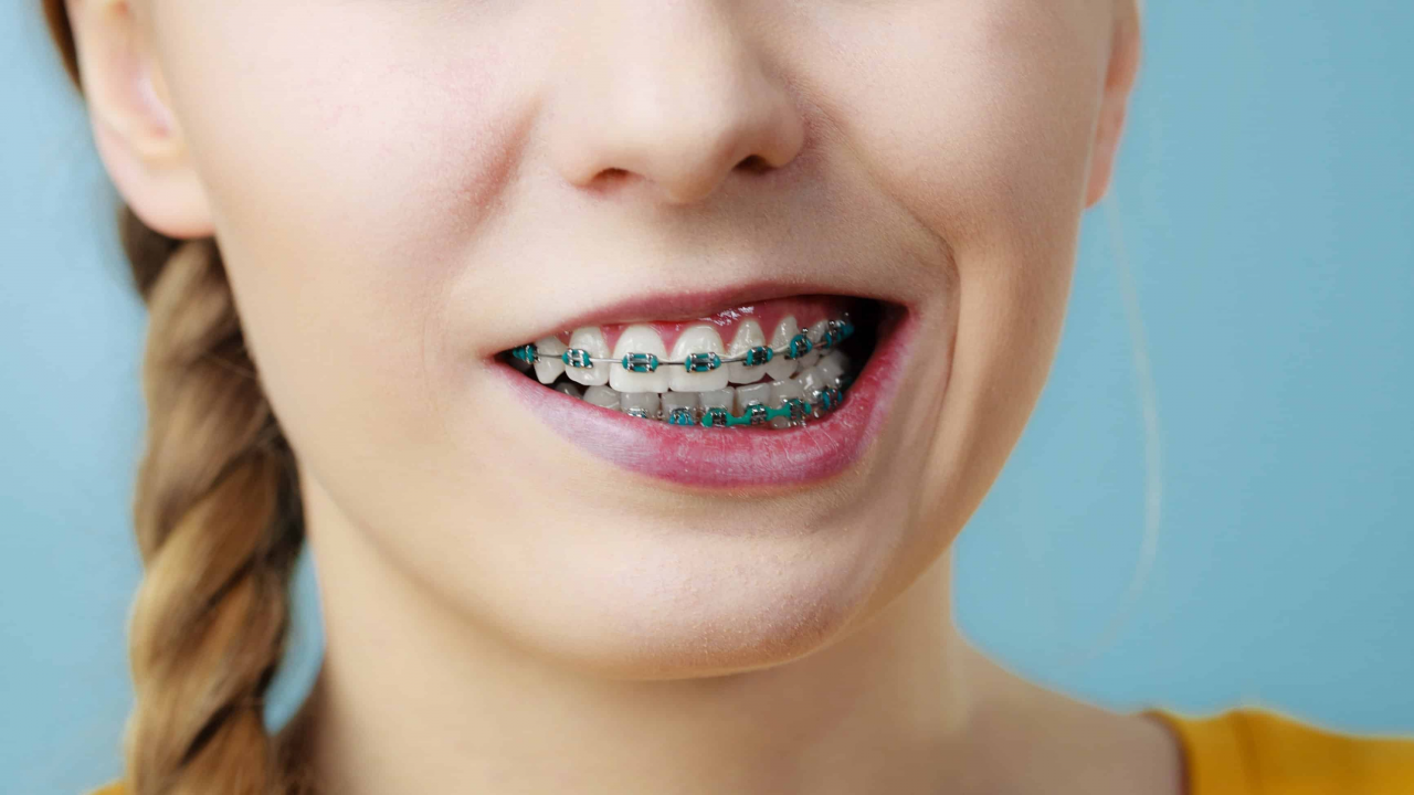 Diş Teli Varken Diş Eti Şişmesi Nasıl Geçer?
