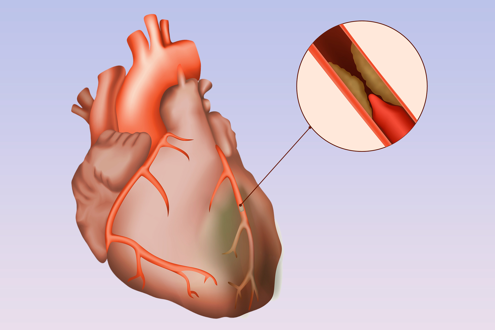 Ишемия боковой. Ишемическая болезнь сердца (ИБС). Атеросклероз венечных артерий.