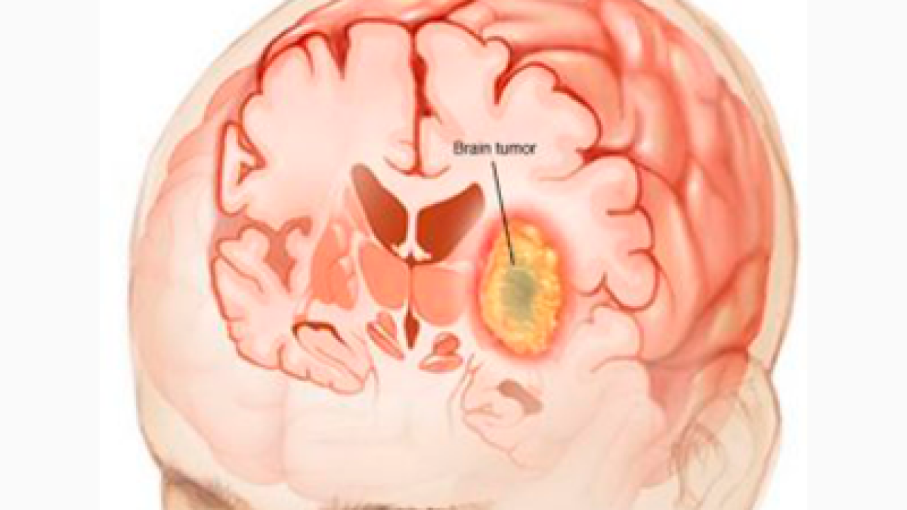Опухоли гм. Глиобластома головного мозга. Новообразование в головном мозге. Объемное образование головного мозга.